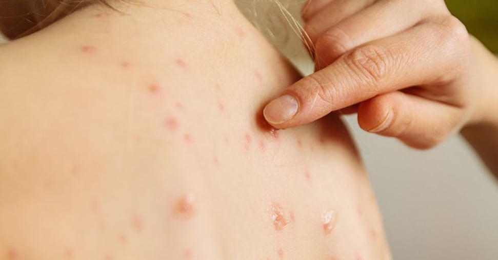 Morbillo: salgono i contagi, in un caso su tre con epatite e polmonite come complicanze Morbillo: salgono i contagi, in un caso su tre con epatite e polmonite come complicanze