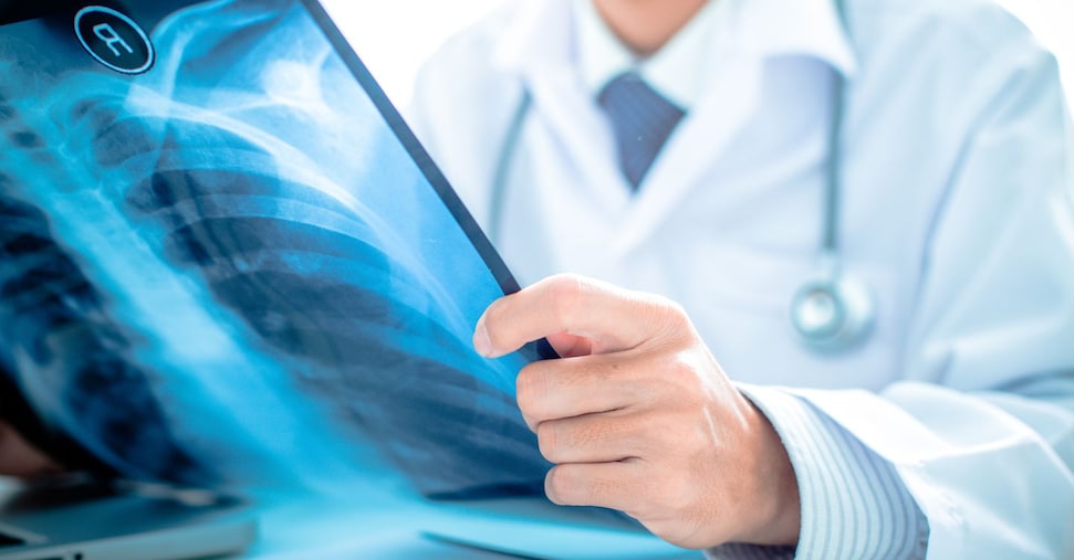 Tumore al polmone: lo screening con la Tac funziona e può evitare oltre 36mila decessi