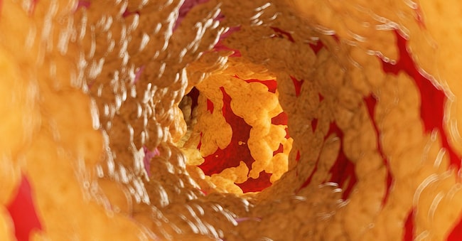 Illustration of fat inside of an artery. 3DMEDISPHERE/SCIENCE PHOTO LIBRARY / AGF