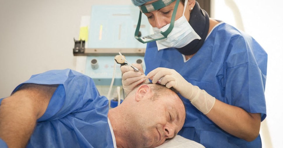 Trapianti di capelli, in Europa cresce il business e si moltiplicano le cliniche low cost
