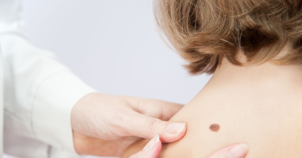 Melanoma, so the 'fixed' mRNA vaccine doubles responses in severe patients - Il Sole 24 ORE