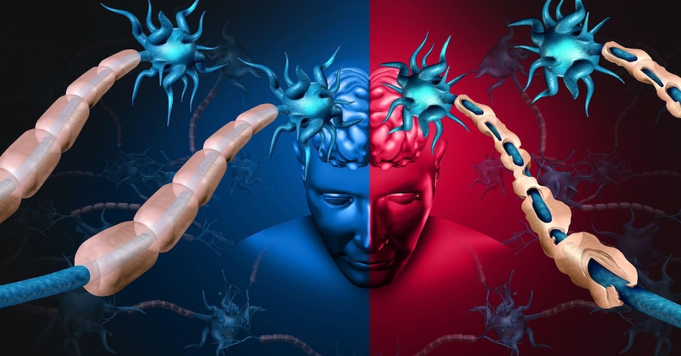 Quando la «malattia del bacio» anticipa la sclerosi multipla