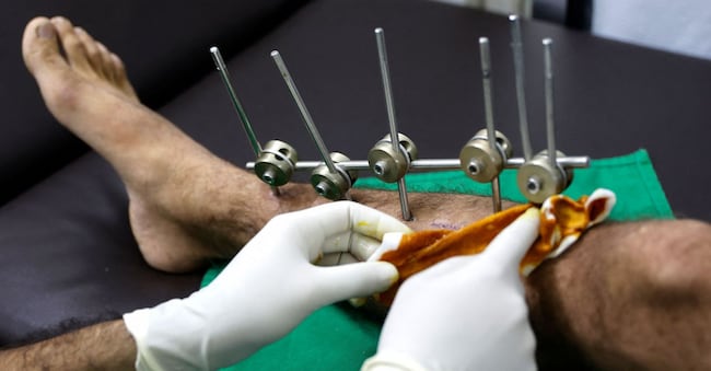 Un paziente palestinese viene medicato presso la clinica di Medici Senza Frontiere (MSF) nel quartiere al-Rimal della città di Gaza alla vigilia di Capodanno, il 31 dicembre 2025. Israele ha dichiarato che dal 1° gennaio 2026 è stato  vietato di operare a Gaza a 37 organizzazioni umanitarie, a meno che non si conformino alle linee guida che richiedono informazioni dettagliate sul personale palestinese (Foto di Omar AL-QATTAA / AFP)