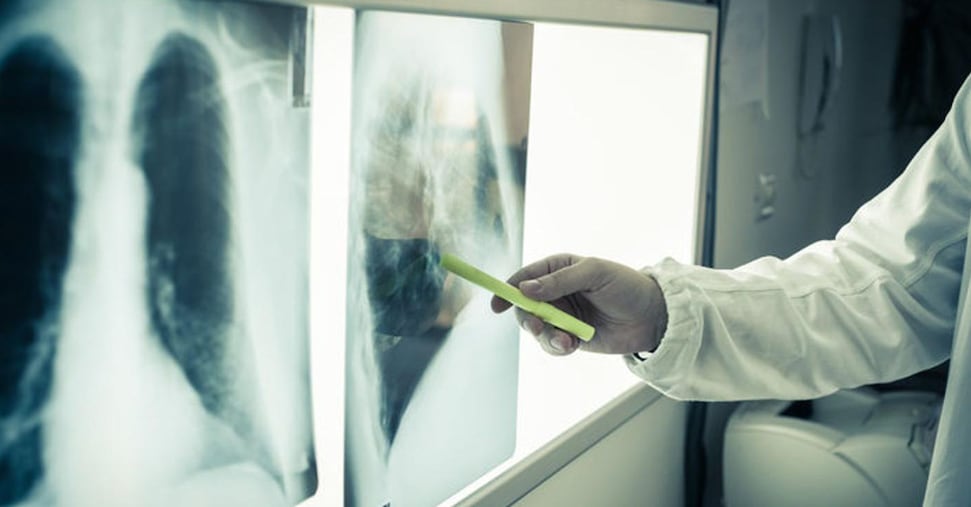 Tumori, mortalità in calo nell’Unione europea  e dati positivi per il polmone nelle donne: ecco le stime per il 2026