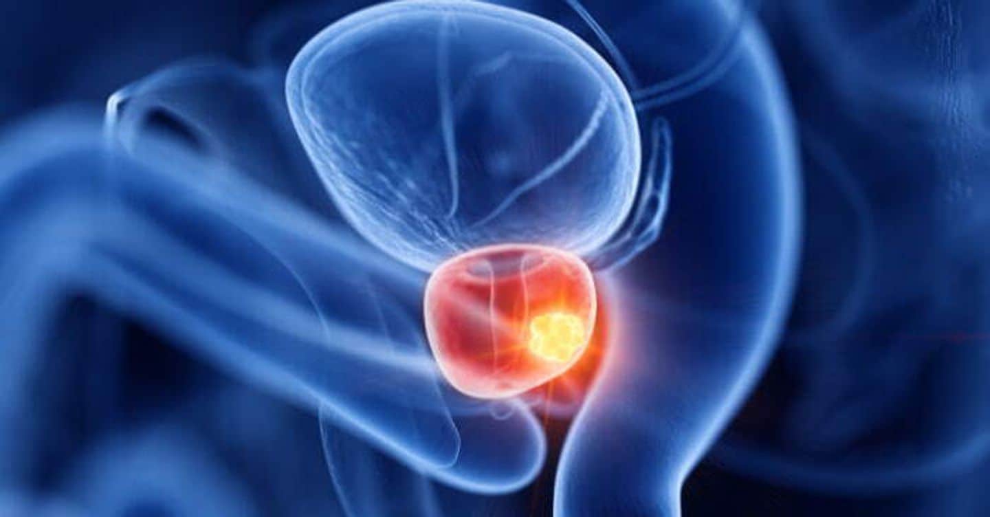 Tumore alla prostata, 1 milione per la ricerca a guida italiana con gli “avatar” del paziente per bloccare la malattia e scegliere il farmaco giusto