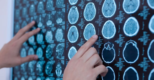 Professional medicine. Close up of x ray images of human brain being put on the whiteboard by a nice professional oncologist zinkevych - stock.adobe.com