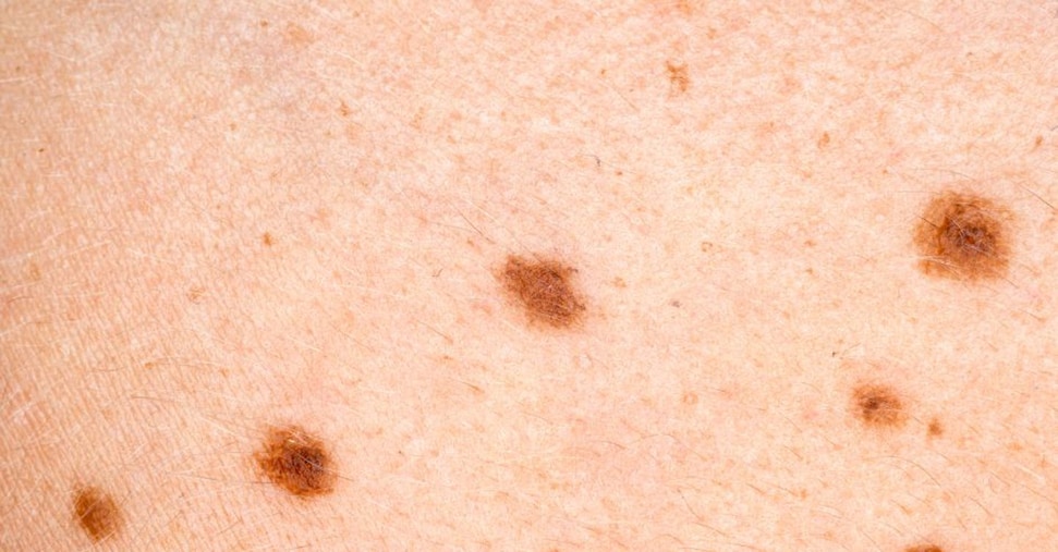 Melanoma, il vaccino a mRna taglia  del 49% il rischio di recidiva a 5 anni
