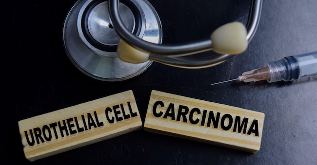 Test carcinoma uroteliale metastatico. (Alamy Stock Photo)