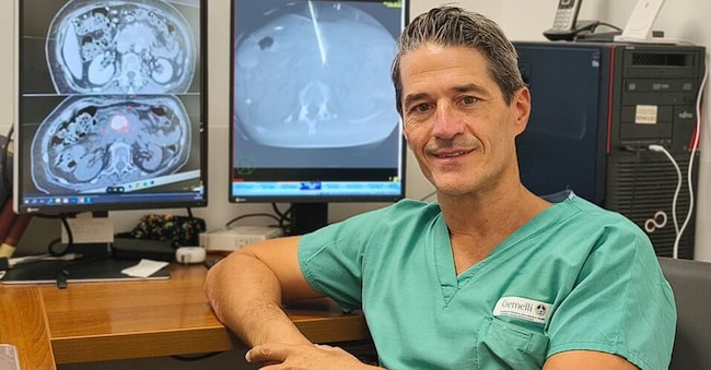 Roberto Iezzi, direttore di Radiologia interventistica al Policlinico Gemelli di Roma, ha effettuato il primo trattamento con colla radioattiva su tumore al pancreas non operabile