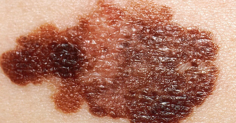 Melanoma avanzato, la nuova pillola  che «spoglia» il tumore e lo rallenta