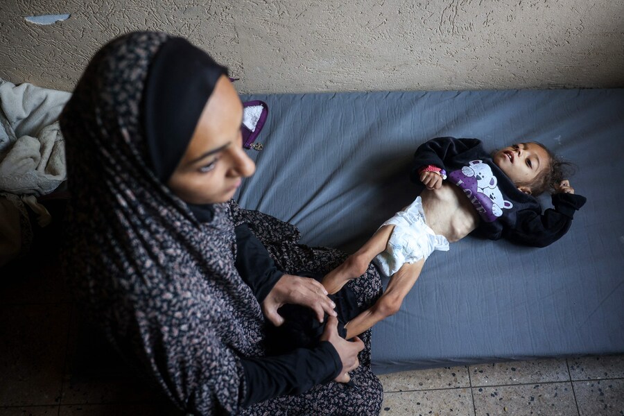 Una madre palestinese cambia i vestiti alla figlia di cinque anni che soffre di malnutrizione. (Eyad BABA / AFP)