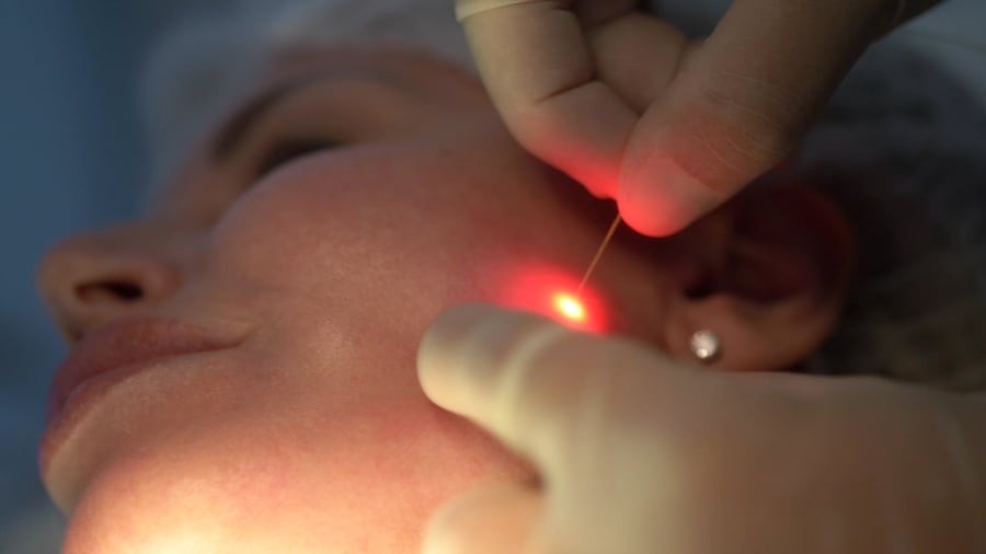 EndoliftX di Eufoton, il laser a fibre ottiche con un background chirurgico in una sola seduta permette di migliorare l’ovalizzazione del volto, togliendo il grasso e assicurando un effetto tightening per lungo tempo. Indicato anche per altre aree di viso&corpo.
