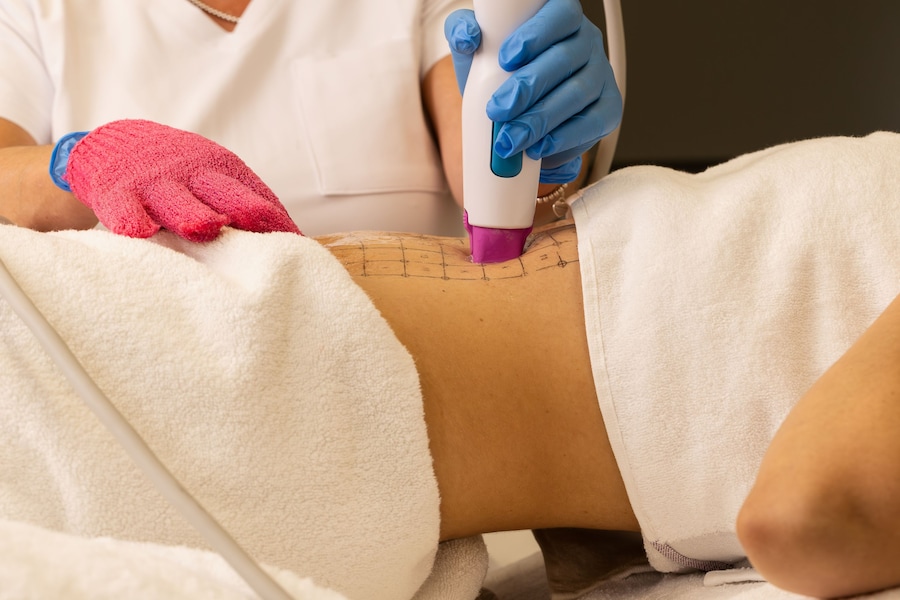 Thermage FLX by Solta Medical utilizza la radiofrequenza monopolare per agire in profondità sul derma, stimolare nuovo collagene e migliorare progressivamente compattezza e qualità della pelle di viso&corpo. E’ sufficiente una sola seduta per dei risultati.