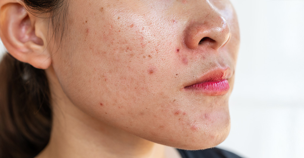 Acne: cos'è, cause e cura