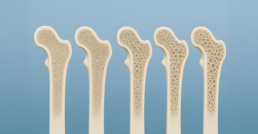 Giornata Mondiale dell'Osteoporosi