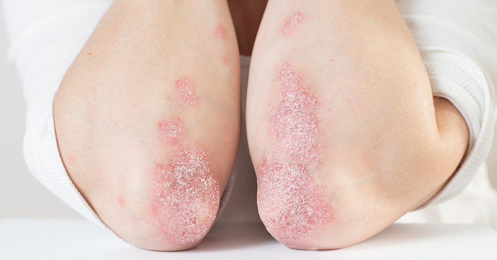 Giornata Mondiale della Psoriasi