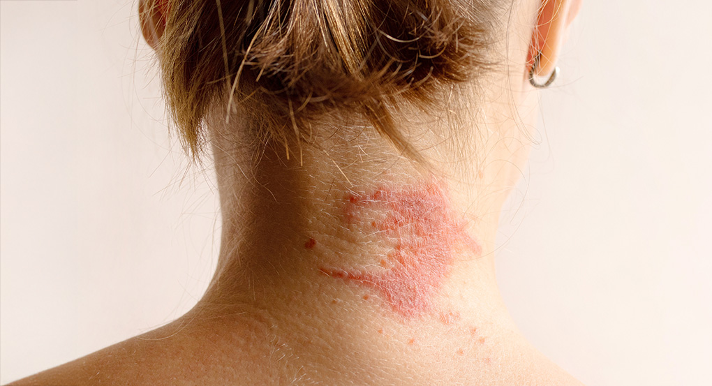 Dermatite atopica negli adulti e nei bambini Dermatite atopica negli adulti e nei bambini