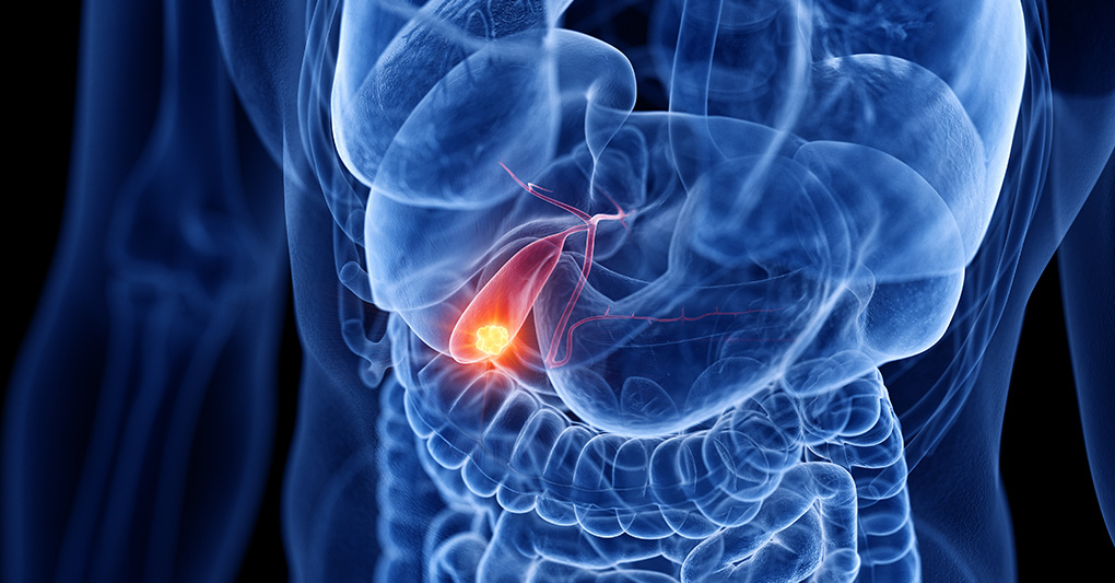 Bilirubina alta e Sindrome di Gilbert