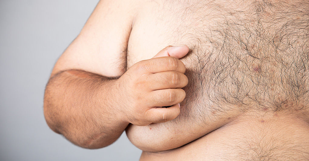 Ginecomastia: il cambiamento che pesa sull'autostima maschile