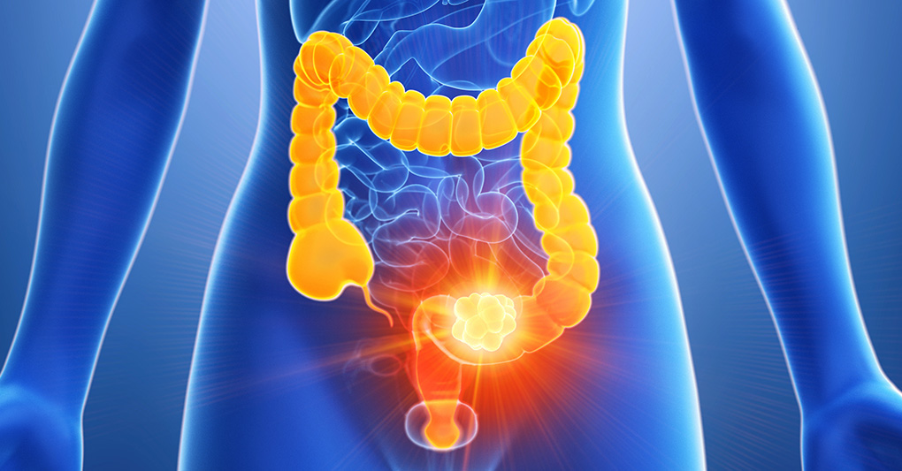 Tumore al colon retto e attività fisica