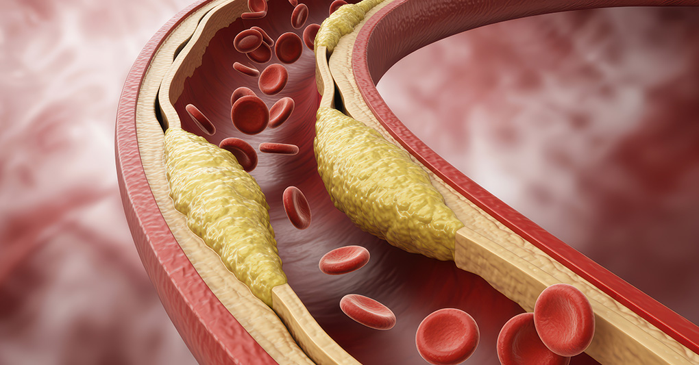 Trigliceridi alti: cause, rischi e come abbassarli