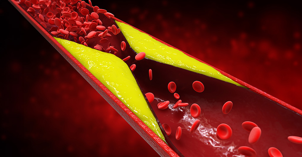 Colesterolo e cuore: perché oggi la prevenzione inizia prima