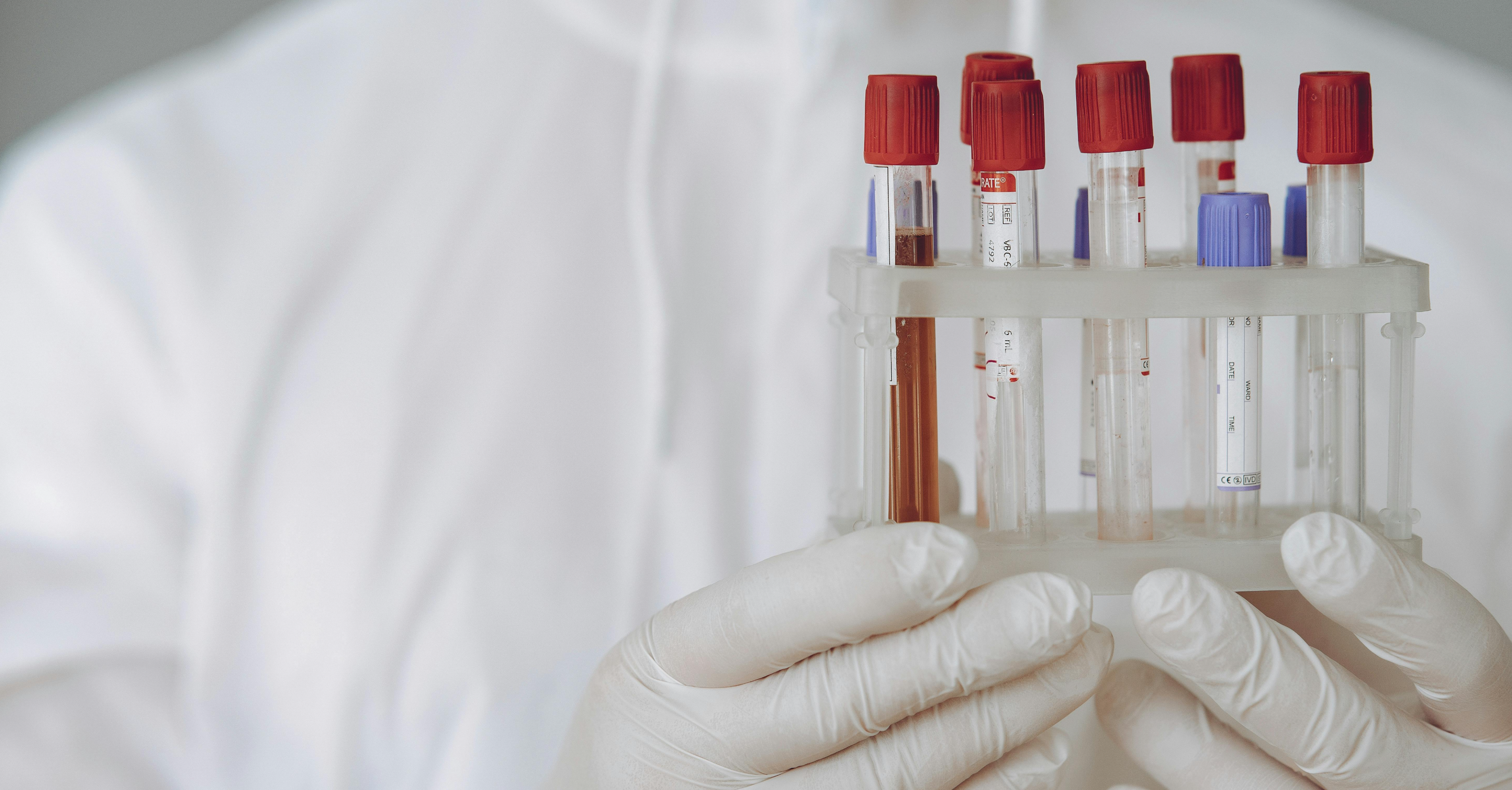 Epatite A, boom di ricoveri al Cotugno di Napoli