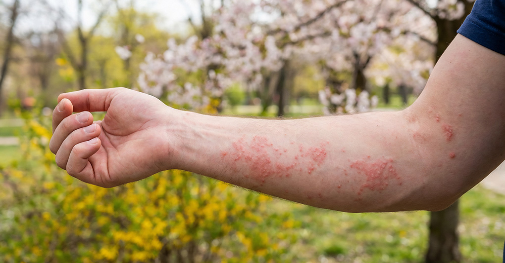 Pelle e luce: quando il sole può aiutare dermatite atopica, psoriasi e vitiligine