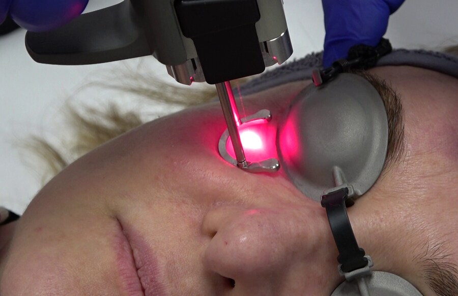 Trattamenti viso con laser Quanta System