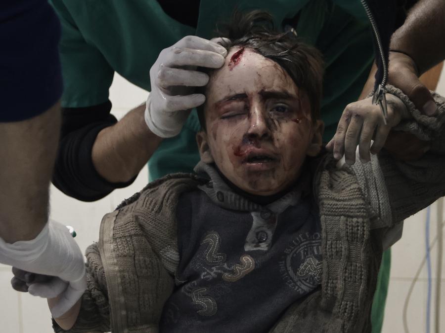Un bambino palestinese ferito nel bombardamento israeliano della Striscia di Gaza riceve cure all’ospedale Nasser di Khan Younis, nel sud della Striscia di Gaza. (AP Photo/Mohammed Dahman)