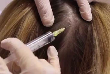 La mesoterapia capillare è un valido metodo per frenare la caduta e si può effettuare nello studio Juva a Milano