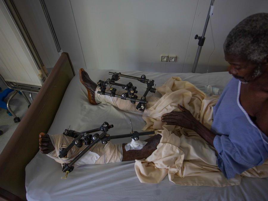 Haiti: Nell'ospedale di Tabarre dopo il terremoto. Un uomo guarda i fissatori esterni sulle sue gambe, ferite durante il terremoto di magnitudo 7.2 del 14 agosto. Ospedale traumatologico di Tabarre. Haiti, Agosto 2021. Ph: Steven Aristil